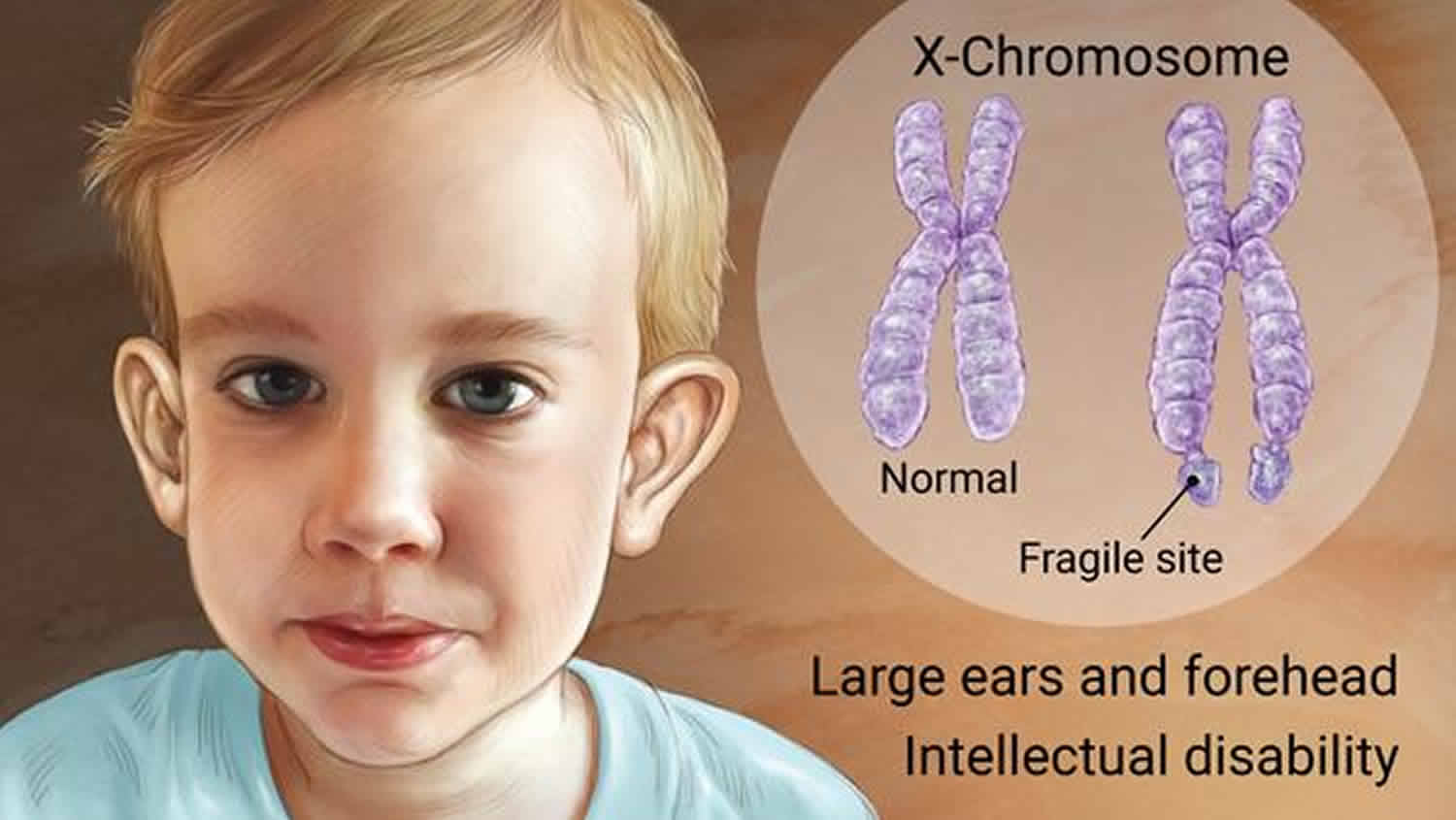 Х хромосома это мужская. Синдром фрагильной (ломкой) х-хромосомы.